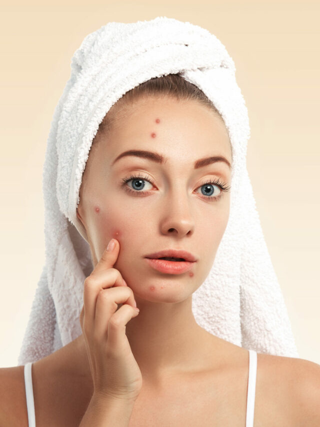Easy Tips to Remove Acne